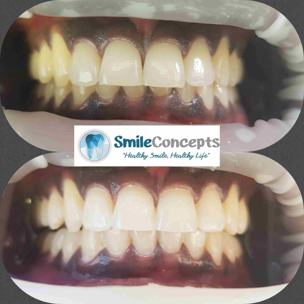 Durban Teeth Whitening Pro Durban's Best Dentist